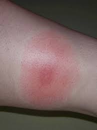 Tiger mosquitoes